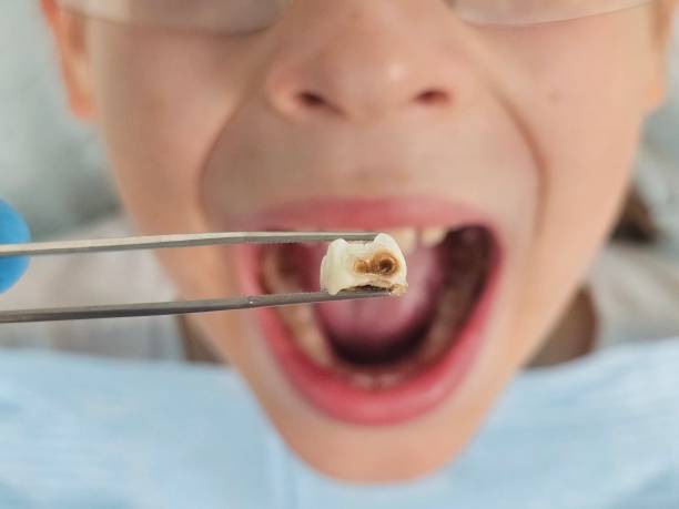 Best Knocked-Out Tooth (Avulsed Tooth) Treatment in Tipton, IN