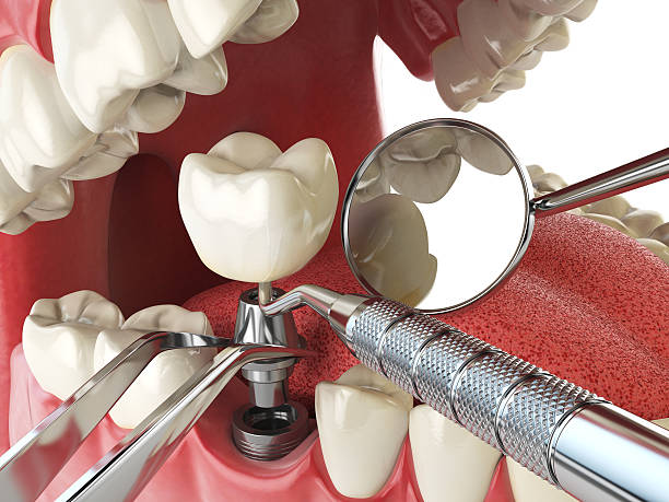 Best Dental Abscess Treatment in Tipton, IN